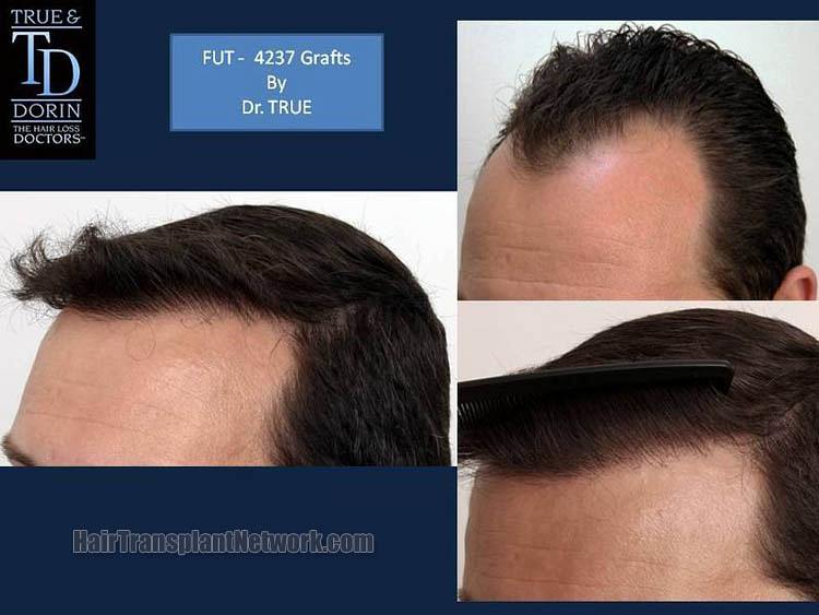 Dr. Robert True Hair restoration surgery before and after result images