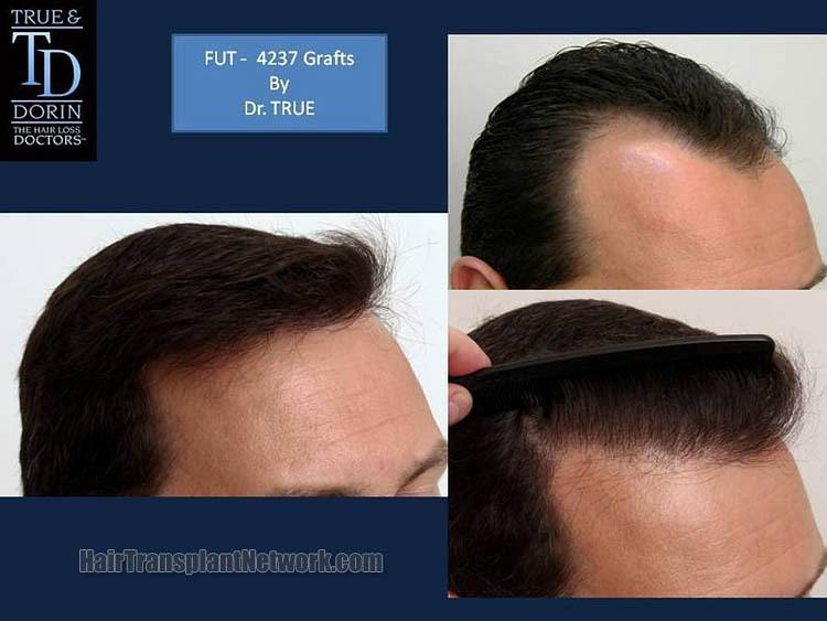 Dr. Robert True Hair restoration surgery before and after result images