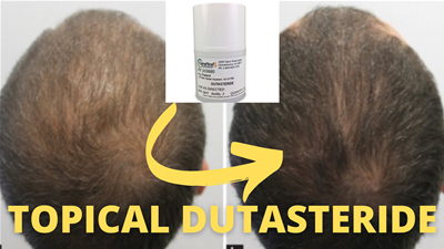 topical dutasteride and mesotherapy results