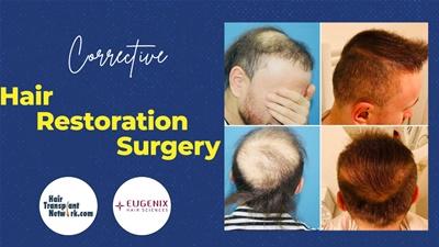 How To Avoid Corrective Surgery Don't Be A Hair Transplant Repair Patient - Dr. Pradeep Sethi