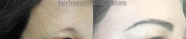 Eyebrow transplantation surgery before and after images