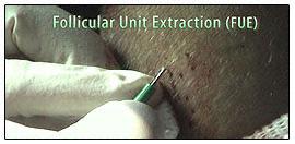The follicular units are extracted