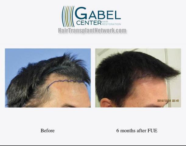 Hair restoration procedure before and after results