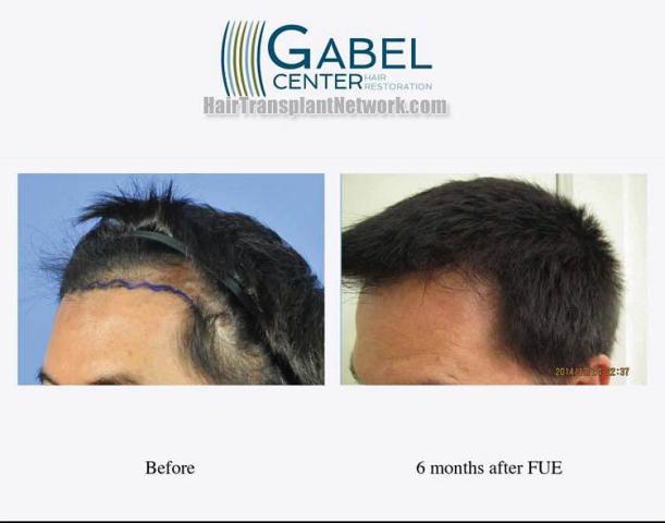 Hair transplantation surgery before and after photos