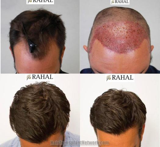 Before and after hair transplantation result photographs