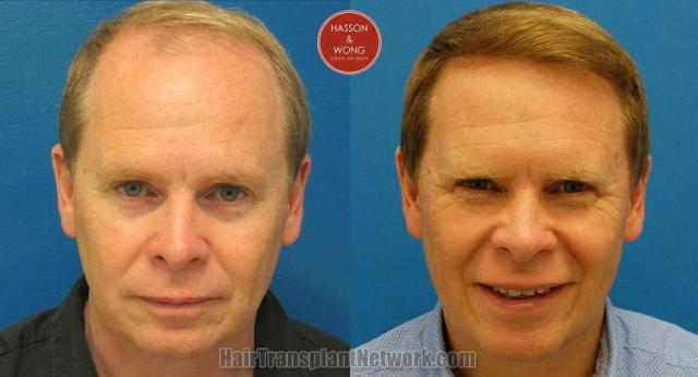 Front view - Before and after hair transplant surgery