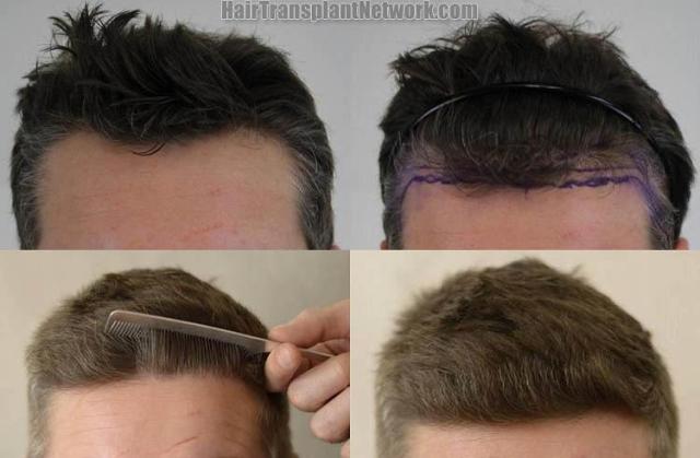 Hair restoration procedure before and after results