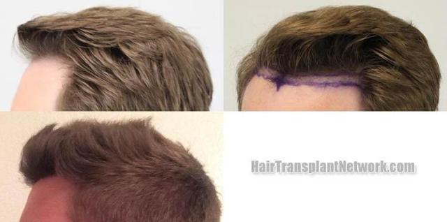 Hair transplantation surgery before and after photos