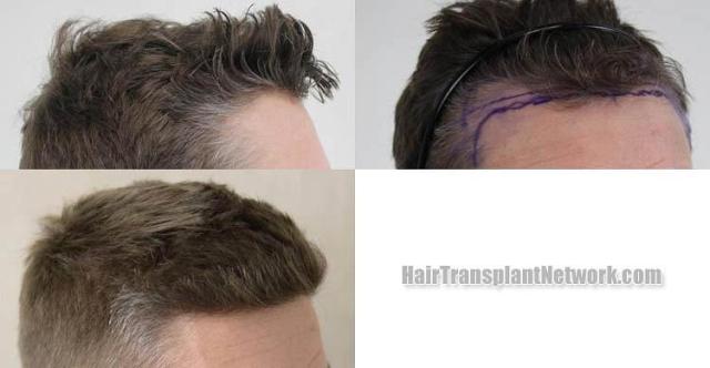 Hair transplantation surgery before and after images