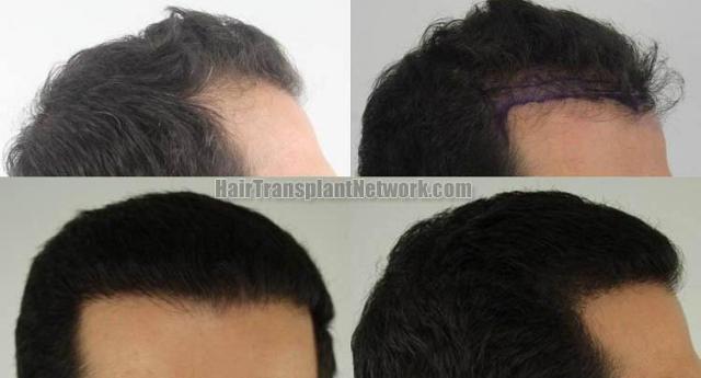 Hair transplantation surgery before and after images