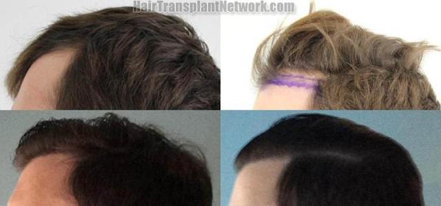 Hair transplantation surgery before and after pictures