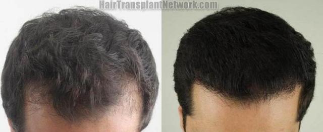 Hair restoration procedure before and after results