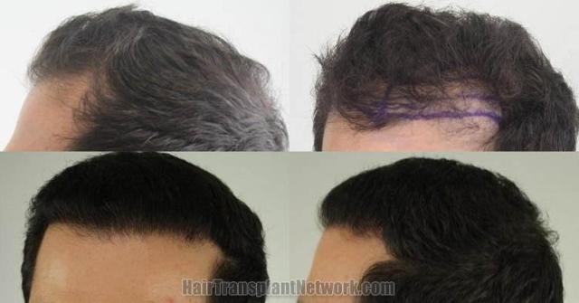 Hair transplantation surgery before and after pictures