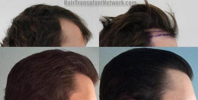 Hair transplantation surgery before and after images