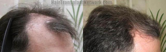 Hair transplantation surgery before and after pictures