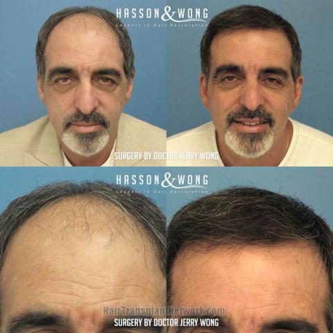  Before and after hair restoration procedure