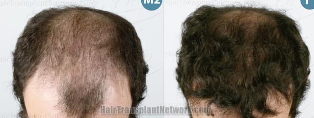 Hair restoration surgery before and after result photographs
