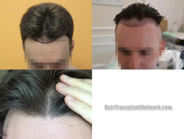 Hair transplantation surgery before and after pictures