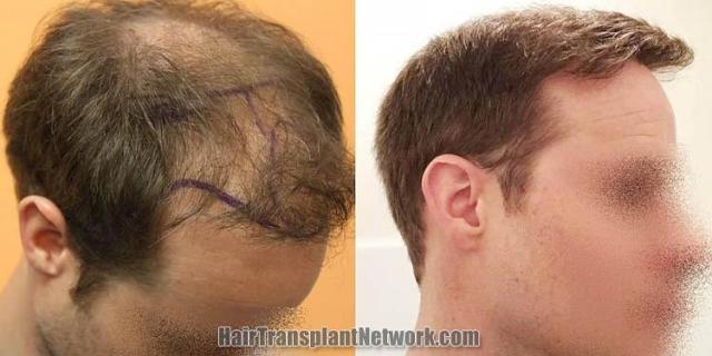 Hair transplantation procedure before and after results