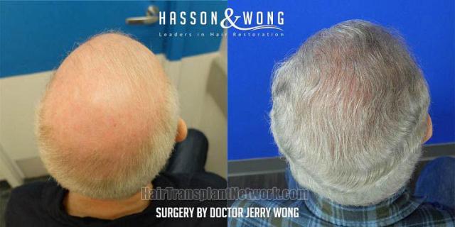 Hair restoration procedure before and after result images