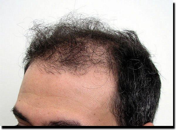 Hair restoration procedure results