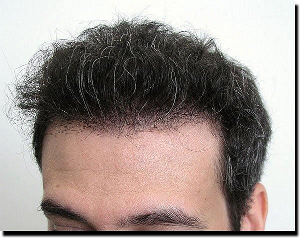 Hair restoration procedure results