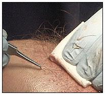 Grafts are placed into the incisions