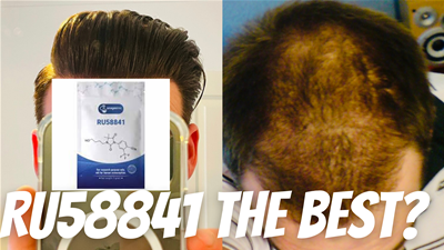 News Is Ru58841 The Best Topical Dht Blocker For Hair Loss News Is Ru58841 The Best Topical Dht Blocker For Hair Loss