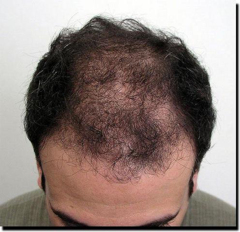 Hair restoration procedure results