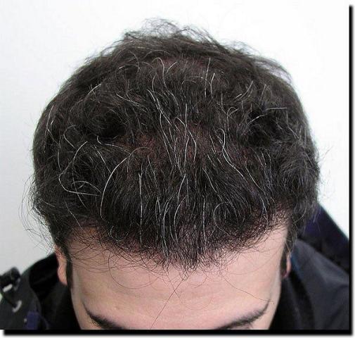 Hair restoration procedure results