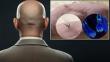 Stemson Therapeutics Raises 22.5 Million Dollars to Cure Hair Loss
