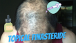 Why Isn't Topical Finasteride and Dutasteride More Popular?