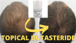 Topical Dutasteride Effective For Hair Loss