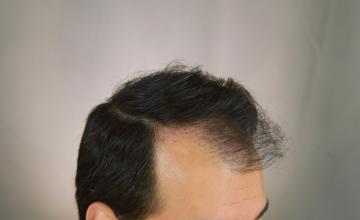 Dr. Arocha | FUT + FUE Procedure Over 4 Years