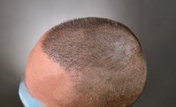 Dr. Arocha | 1500 Graft FUE Repair Case | 1 Year Results