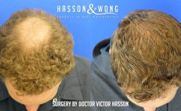 Dr. Hasson / 3,004 Grafts / FUE/ Crown / 1 Session / 6 months post-op