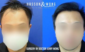 Dr. Wong / 2165 grafts / Hairline/Front / FUE / 1 Session / 7 months post-op