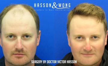 Dr. Hasson /6,048 Grafts/ FUE/ 1 Session/ 10 months post-op