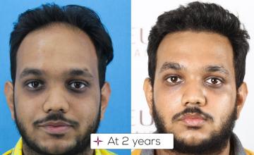 2 Years Hair Transplant Update | Grafts 2808, Norwood Grade 4A @Eugenix Hair Sciences