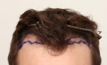 Dr. DORIN - Restoration initiation - Hairline FUE