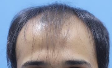 Eugenix India - 15 Months Hair Transplant Update | 2670 Grafts Norwood Grade 4A