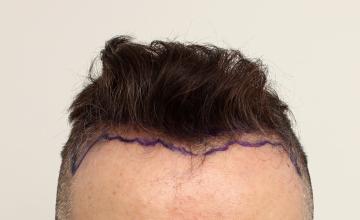 Dr. Robert Dorin ~ Fortifying the Hairline ~ FUE