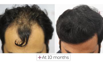 10 months hair transplant update - 2560 Grafts Norwood Grade 4A @Eugenix Hair Sciences