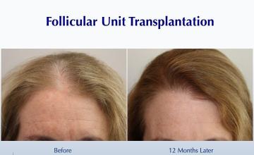 Healthier Female Partline (1591 FUT grafts): Carlos K. Wesley, M.D. (NYC & LA)