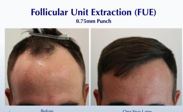 My Original Hairline is Back! (2701 FUE grafts): Carlos K. Wesley, M.D. (NYC & LA)