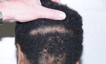 Dr. Arocha | FUT in a Keloid Prone Patient