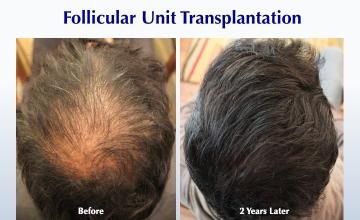 No More Bald Crown (2201 FUT grafts): Carlos K. Wesley, M.D. (NYC & LA)