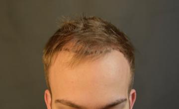 Dr. Arocha | 2000 Graft FUE+PRP | 18 Month Results