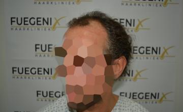 Dr. Munib Ahmad 2645g - Hairline - FueGenix - The Netherlands