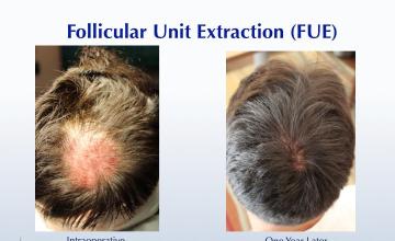 A Crown Reversal with FUE (1228 FUE grafts): Carlos K. Wesley, M.D. (NYC)